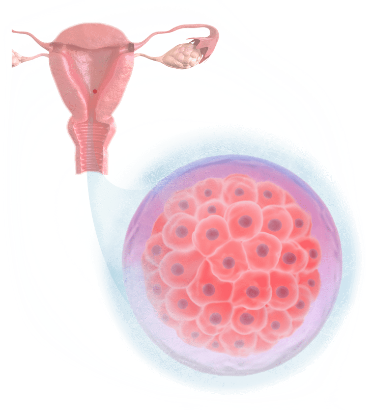 Transferencia de Embriões Congelados